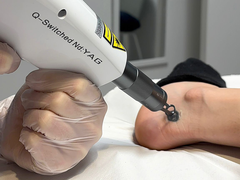 Tecnología láser de vanguardia